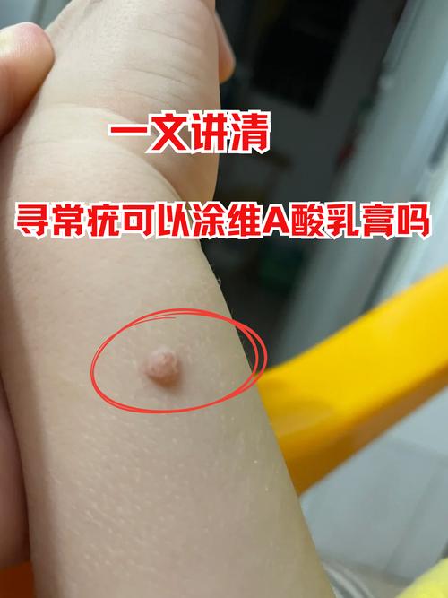 免疫力提升（免疫力提升的话疣会消失吗）