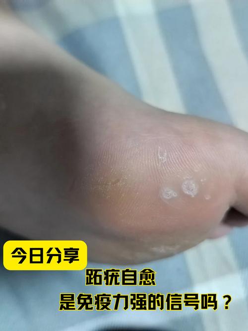 免疫力提升（免疫力提升的话疣会消失吗）