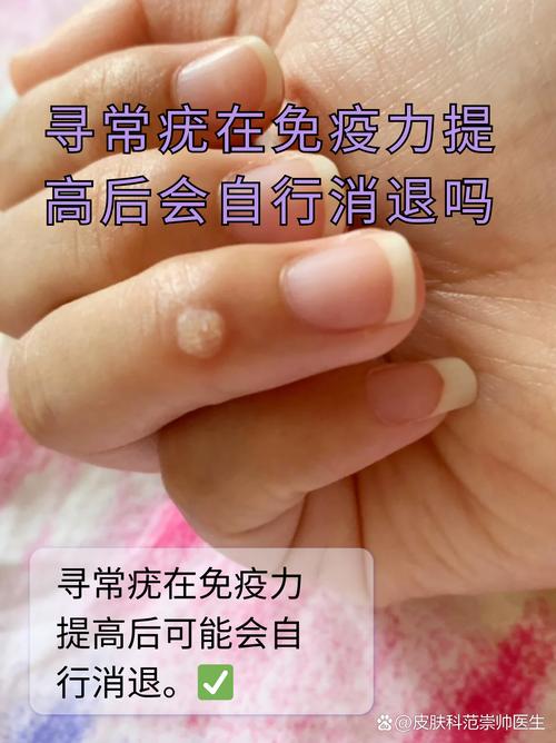 免疫力提升（免疫力提升的话疣会消失吗）