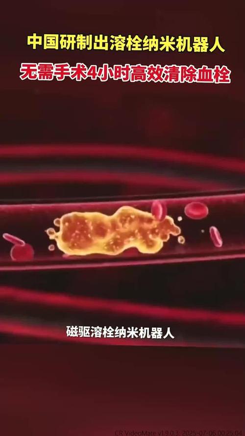 纳米机器人清除血栓实录(纳米机器人溶栓)